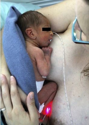 Intéret d’une stimulation sensorimotrice précoce pour un nouveau né avec le syndrome de Prader-Willi
